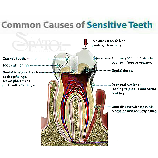 حساسیت دندانی