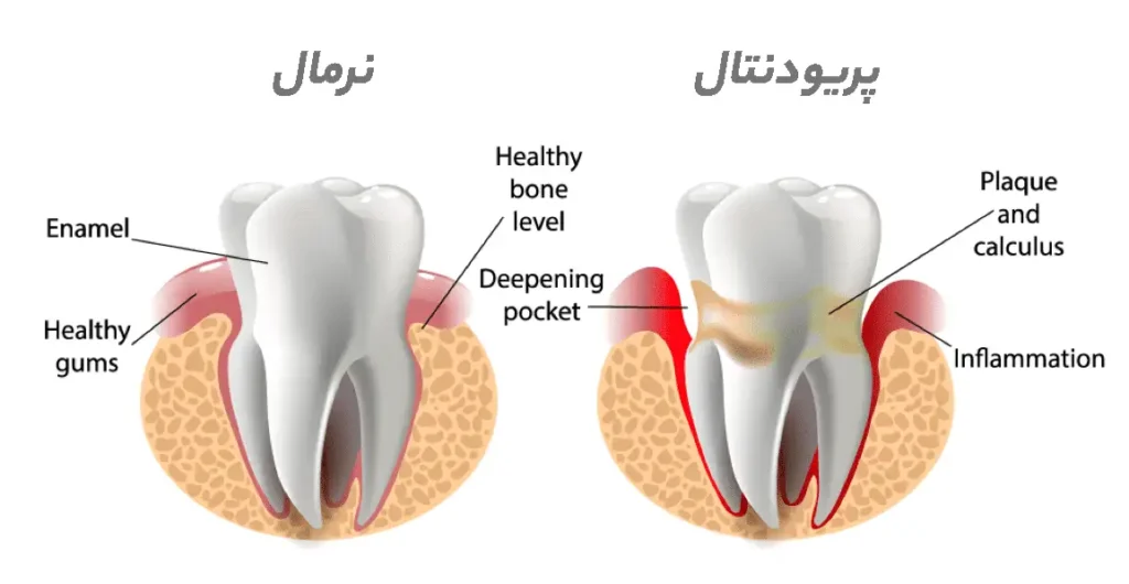 بیماری های پریودنتال یا التهاب لثه خفیف و التهاب لثه مزمن