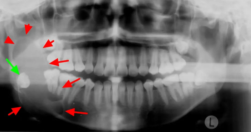 آملوبلاستوم (Ameloblastoma) - تومور خوش خیم فک