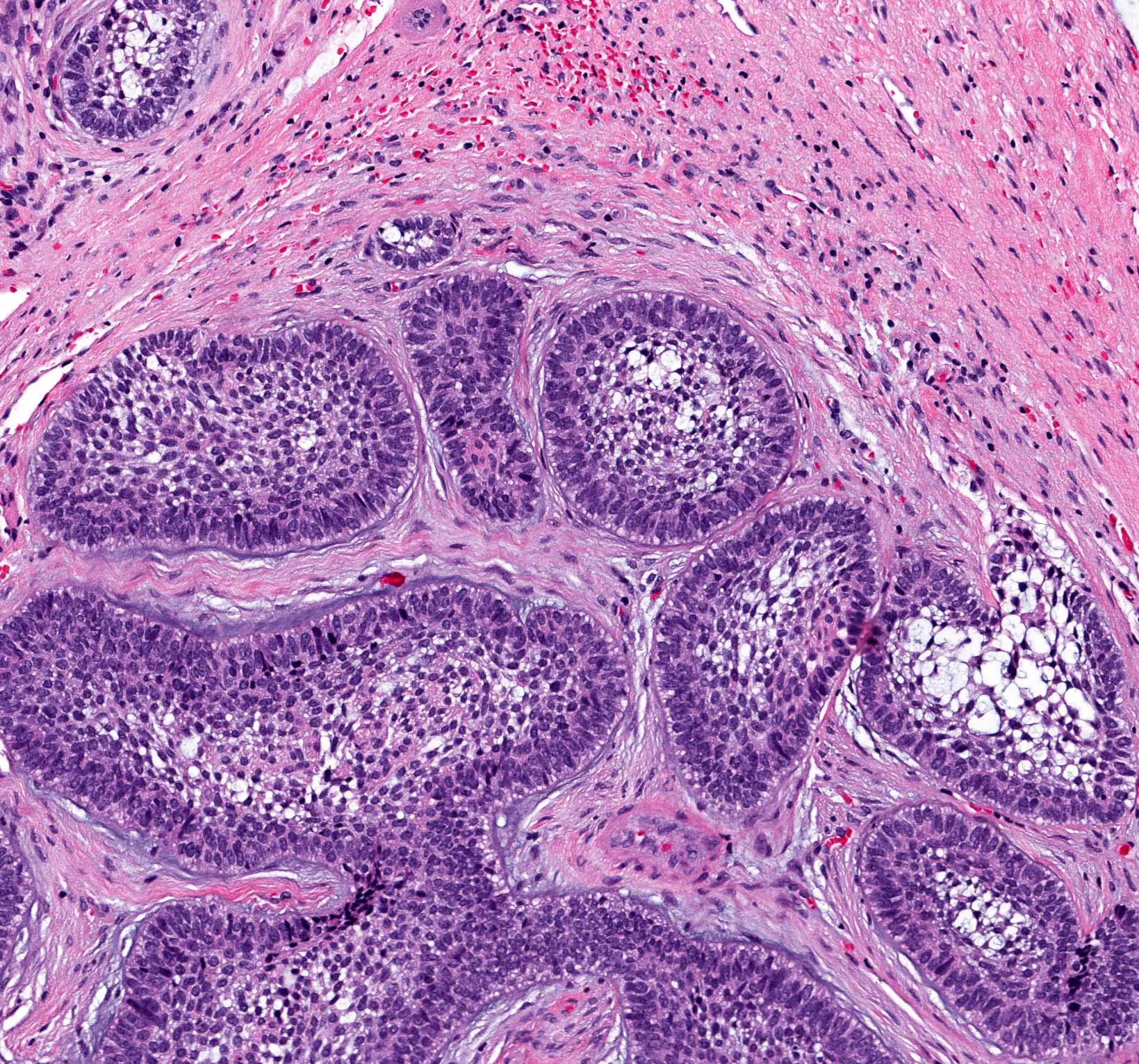 آملوبلاستوم (Ameloblastoma) - تومور خوش خیم فک